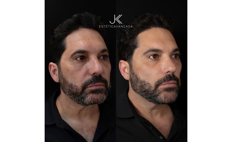 Edson, dupla de Hudson, passa por procedimento estético de rejuvenescimento na JK Estética Avançada Saiba o valor!